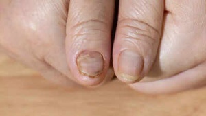 Fragile Nails: More Than Just a Cosmetic Issue? Potential Health Problems Revealed