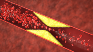 Healthy Living Isn't Always Enough: 74-Year-Old's High Cholesterol Battle Highlights Hidden Factors, Expert Says