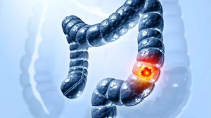 ​8 deadly colon cancer signs that should not be ignored, according to a top gastroenterologist