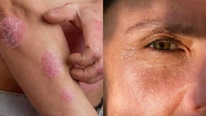 Smoking's Toll on Your Skin: 16 Ways Tobacco Use Can Wreak Havoc