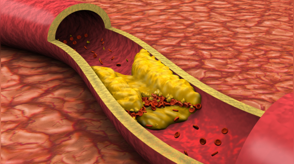 Brain cholesterol