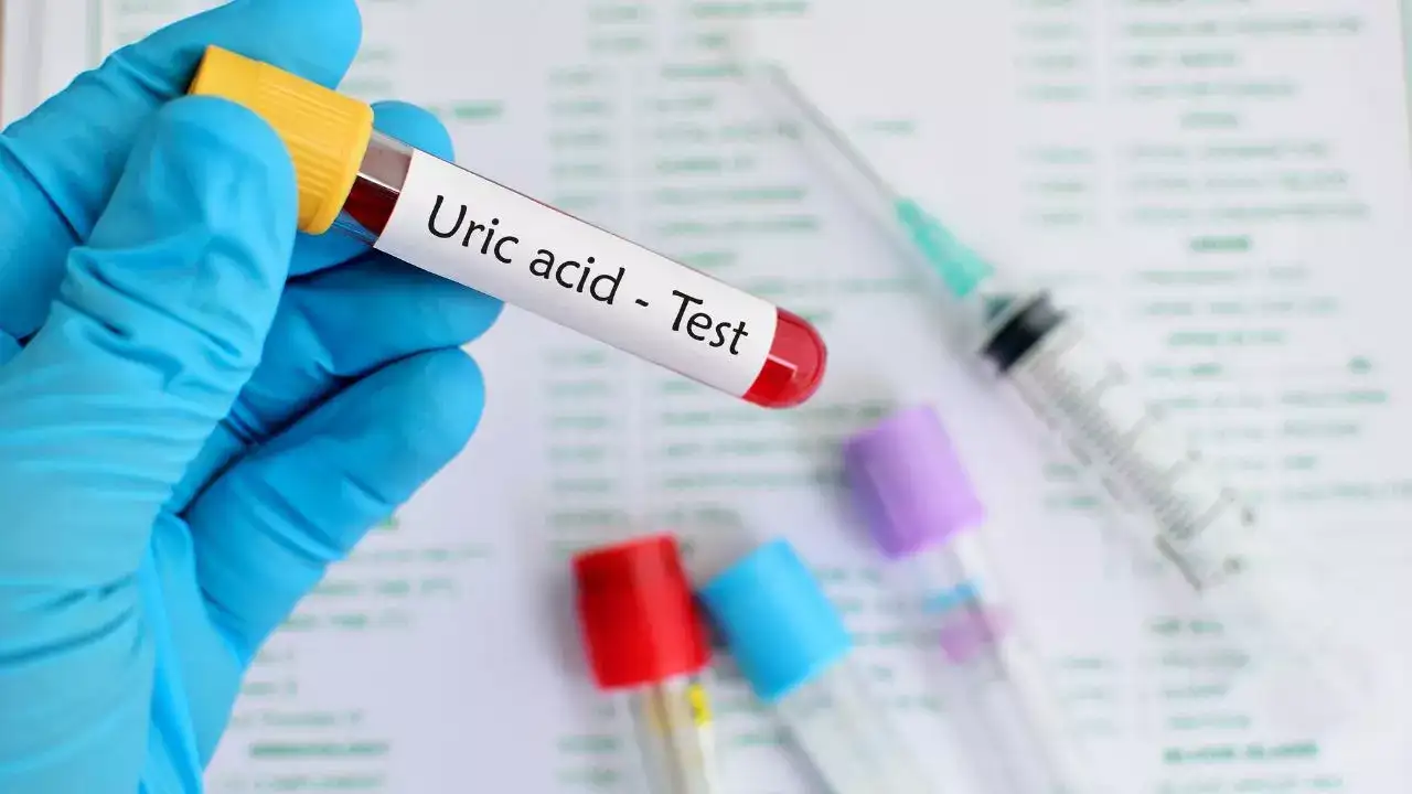 Subtle signs of high uric acid